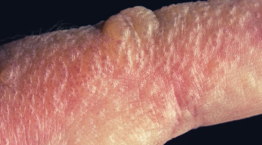 Close up macro poison ivy rash blisters on human skin